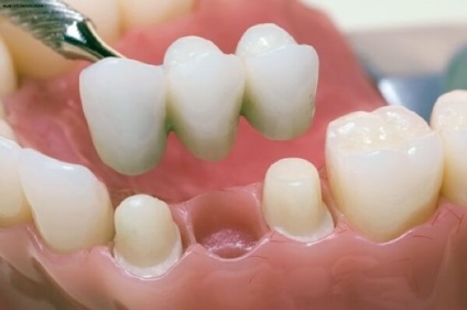 Mik a jellemzői fém korona gyártása és telepítése (metalloplastmassa fogtechnikai) Mik a jellemzői fém korona gyártása és telepítése