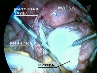 Disgerminoma petefészek okok, diagnózis és kezelés