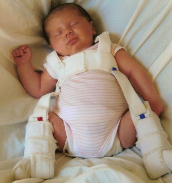 térdízület diszplázia beteg lehetetlen, ízületi deformitás bekövetkezik a születéstől