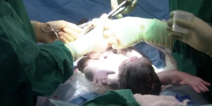 Magzati terápia - méhen belüli műtétek (klinikai vizsgálatok) Magzati terápia - a méhen belüli műtétek