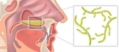 Az orrmelléküreg-gyulladás tünetei és fungicid kezelés, a betegség okait