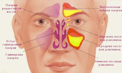 Az orrmelléküreg-gyulladás és a sinusitis okai, a tünetek, különösen a kezelés, megelőzés