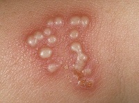 Herpes lábon tünetei és kezelése (herpesz) Herpes lábon tünetek és a kezelés