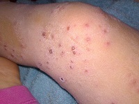 Herpes lábon tünetek és a kezelés (tünetek) Herpes lábon tünetek és a kezelés