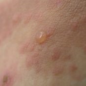 Herpes lábon tünetek és a kezelés (láb) Herpes lábon tünetek és a kezelés
