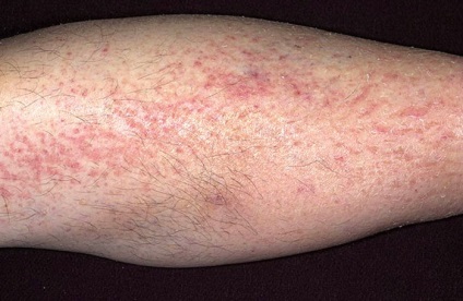 Herpes lábon tünetek és kezelés (aktiválása a vírus típus) Herpes lábon tünetek és a kezelés