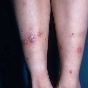 Herpes lábon tünetek és a kezelés (láb) Herpes lábon tünetek és a kezelés