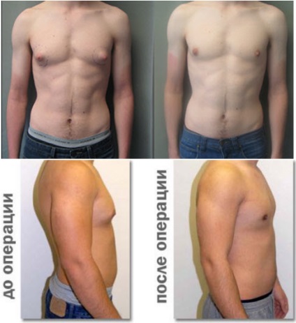 Gynecomastia serdülőknél 12-15 éves