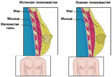 Gynecomastia serdülőknél 12-15 éves