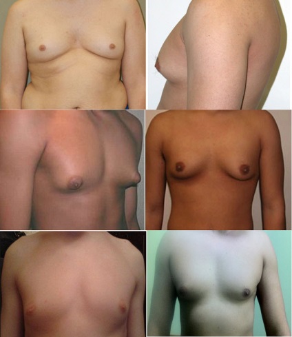 Gynecomastia serdülőknél 12-15 éves