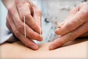 Akupunktúra fogyás módszerek, az akupunktúrás pontokat, az előnyöket és a hátrányokat (kb akupunktúra vélemény)