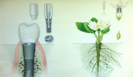 Implantátumok alfa Dent - konstruktív jellemzői, előnyei, árai implantátum alfa Dent - (alfa) Alpha Dent implantátumok - tervezési jellemzőit, előnyeit, az árak implantátumok alfa dent -