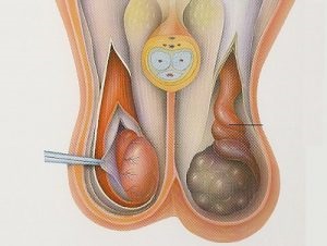 Cyst mellékhere leírás, okait, és a kezelések fajok (Módszerek) Ciszta mellékhere leírás, okai, típusai és kezelések