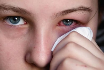 Kötőhártya-gyulladás tünetei és típusai szem