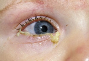 Kötőhártya-gyulladás tünetei és típusai szem