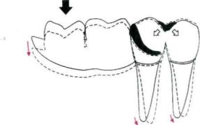Kopicheskie és reteszelő kapcsolódási fogsorok