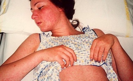 Kanyaró fotó tünetek, mint a betegséget, a nevét a elleni vakcina kanyaró és a szövődmények az oltás után