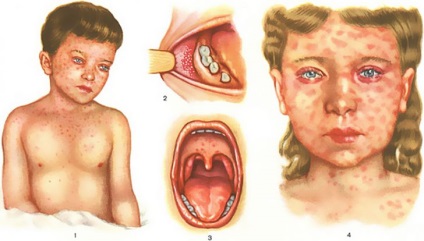 Kanyaró gyermekek tünetei, okai, kezelése a kanyaró, a kanyaró veszélyt jelenthet a gyermekre, kanyaró megelőzésére -