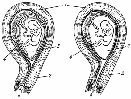 Vérzés a spontán abortusz, szülészeti (spontán) Vérzés a vetélés, a szülészet