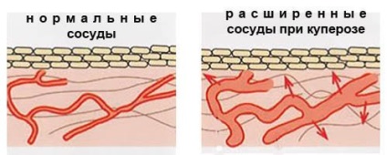 Купероз на обличчі (лікування, препарати, відгуки)