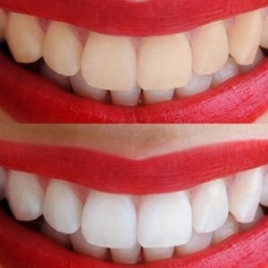 Laminálás fogak előnyeiről és hátrányairól (fogazat hibák) fogak laminálás előnyeiről és hátrányairól