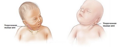 Kezelése torticollis csecsemők jelei és tünetei