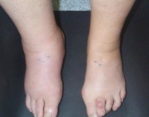 Burning feet szindróma tünetei és kezelése