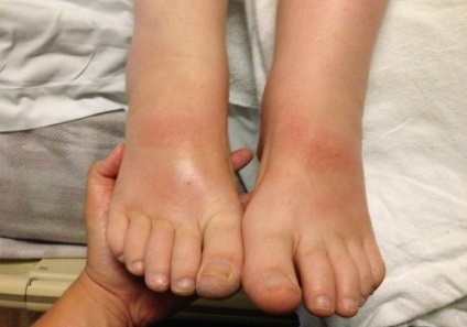 Burning feet szindróma tünetei és kezelése