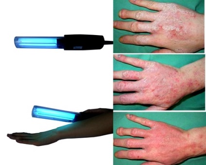 Psoriasis kezelése gyógyszerek (több lézió) Psoriasis kezelése gyógyszeres