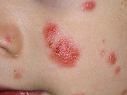 Psoriasis kezelése gyógyszerek (psoriasis) Psoriasis kezelése gyógyszeres
