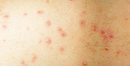 Psoriasis kezelése gyógyszeres