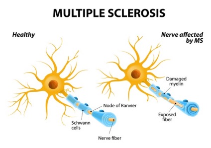 sclerosis multiplex őssejt kezelés véleménye, ár-transzplantáció