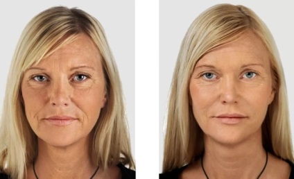 Mezoterápia fogyás ez az eredmény (előtti és utáni képek)