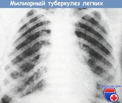 Miliaris tuberkulózis - klinikai kép, diagnózis