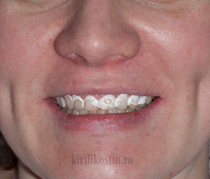 Azonnali fogfehérítés fogorvosi festék lakk