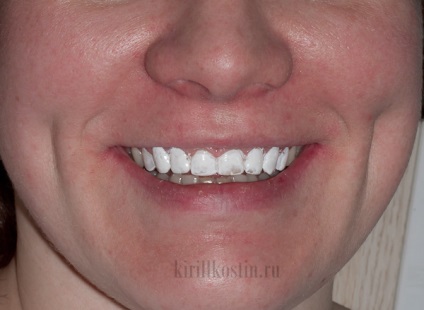 Azonnali fogfehérítés fogorvosi festék lakk