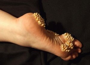 Mi a teendő, ha a lábszár kukorica gyulladt és fáj?, Kukorica a lábujjgyulladáson