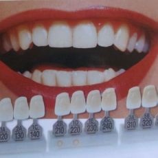 Hamis fogak fogpótlás