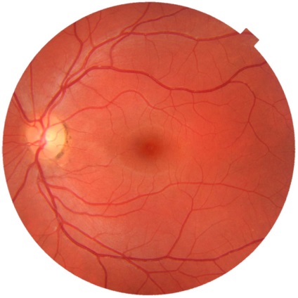 Nystagmus szemre, okai, típusai, diagnózis és kezelés (faj) Nystagmus szemre, okai, típusai, diagnózis és kezelés