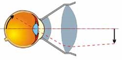 Szemészeti lencse fundus, alkalmazás (letapogatásával a rés fény) Szemlencse szemfenéki segítségével