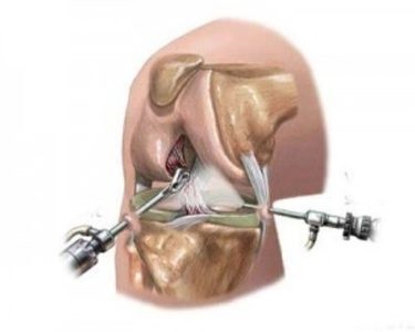 Artroszkópiás műtét a meniszkusz, meniscectomia, transzplantáció