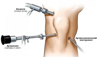 Artroszkópiás műtét a meniszkusz, meniscectomia, transzplantáció