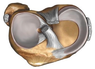 Artroszkópiás műtét a meniszkusz, meniscectomia, transzplantáció