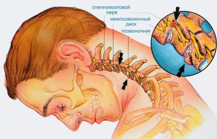 Osteochondrosis a nyaki gerinc tünetek, okok, mértékét, hatásait, a diagnózis és