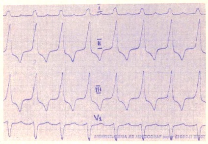 Roham kamrai tachycardia - kezelés a szív