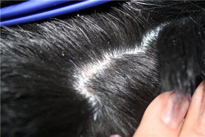 Korpásodást és a zsíros haj okai és megnyilvánulásai, a hagyományos kezelések, és a hagyományos módszerek