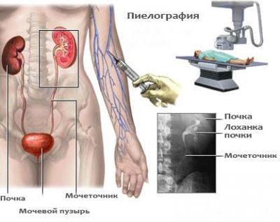 Pyelography és ureteropyelography intravénás, retrográd, antegrád