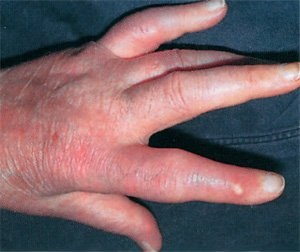 nail gombák on hands népi módszer kezelése