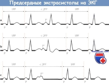 Tünetei pitvari aritmia az EKG (jelei pitvararrhythmia az EKG) Tünetei pitvari aritmia az EKG