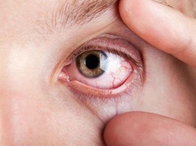 Hideg szem tüneteket okoz és a kezelés